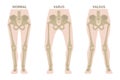 Valgus and varus leg deformities.